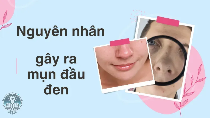 cách trị mụn đầu đen 1