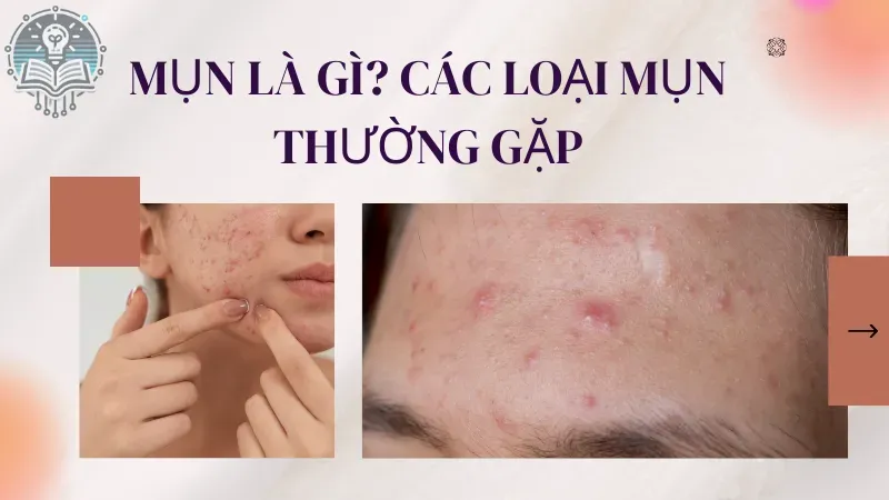 5 loại thuốc trị mụn bác sĩ khuyên dùng 1