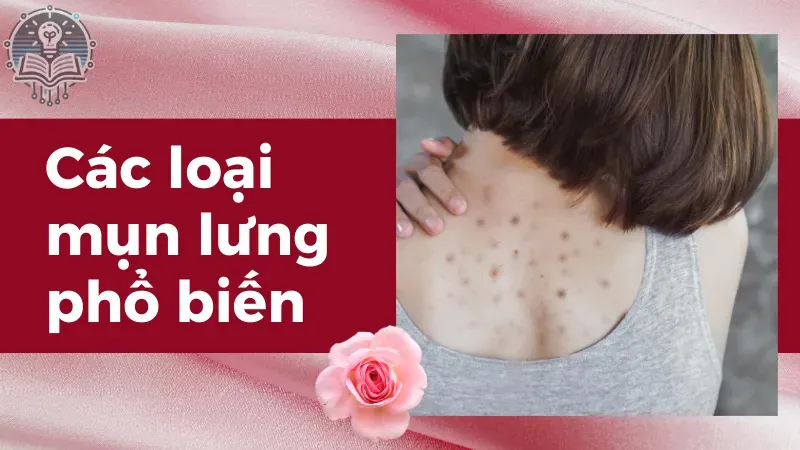 cách trị mụn lưng 2