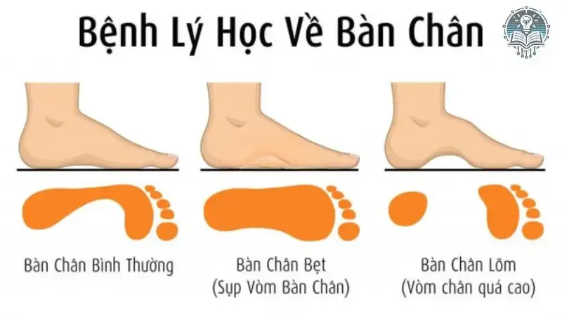 tác hại bàn chân bẹt 4