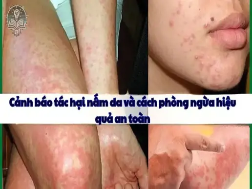 Cảnh báo tác hại do nấm da và cách phòng ngừa hiệu quả an toàn