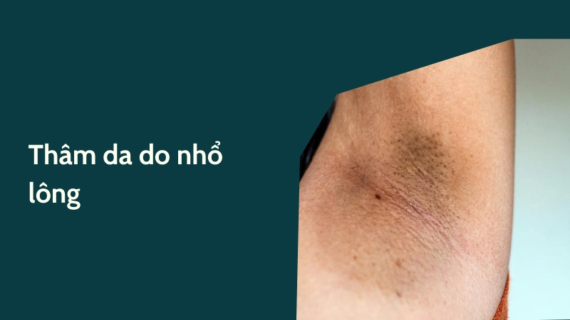 Thâm sạm da do tác hại của việc nhổ lông nách