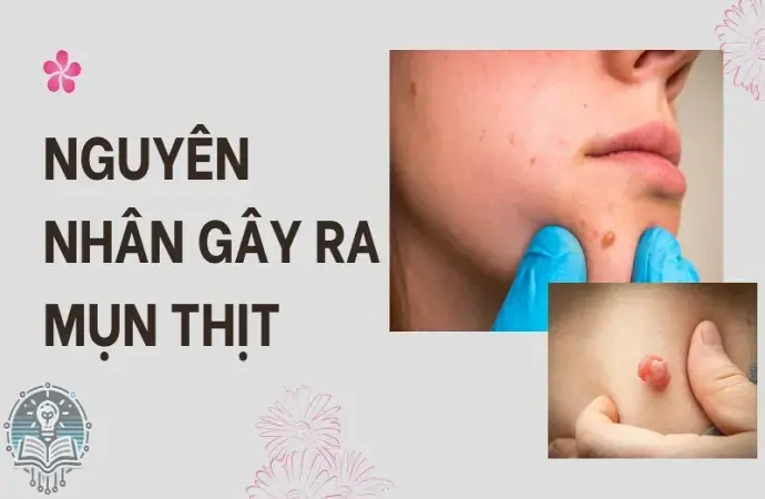 Cách trị mụn thịt an toàn và ngăn ngừa tái phát