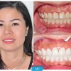 Bí quyết sở hữu nụ cười răng đẹp mê hoặc