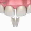 Tác hại của việc trám răng và cách phòng tránh hiệu quả
