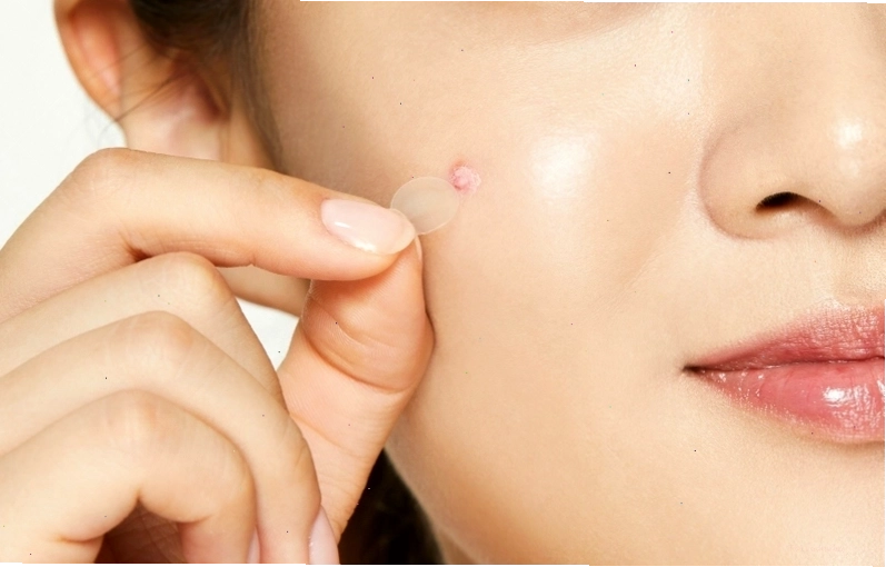 Bác sĩ da liễu tư vấn về tình trạng mụn