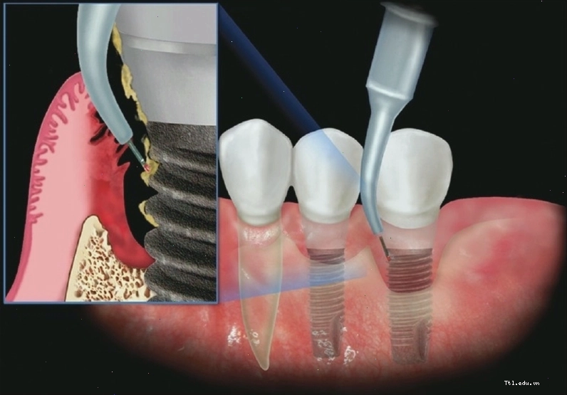 Bác sĩ tư vấn cho bệnh nhân về quy trình trồng răng implant