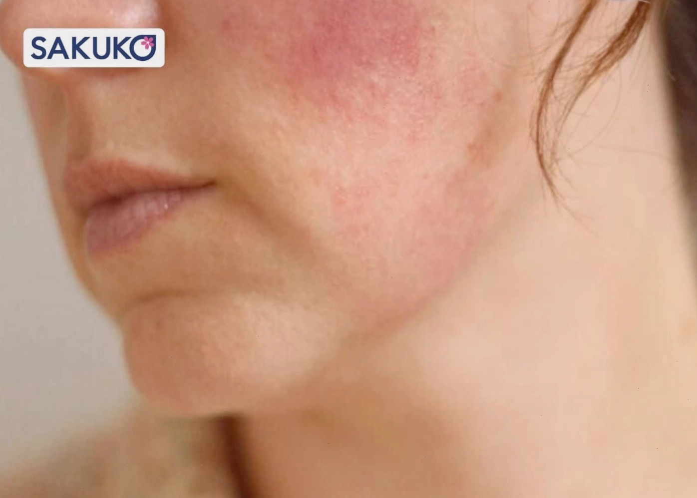 Biến chứng nguy hiểm khi nâng cơ HIFU