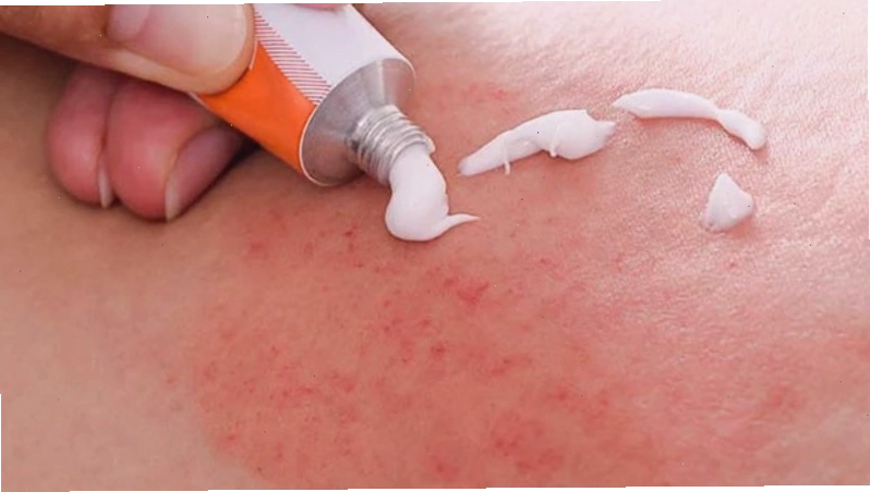 Cảm giác châm chích hoặc bỏng rát khi dùng thuốc corticoid bôi ngoài da