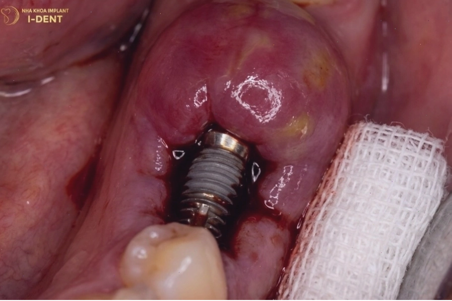 Cận cảnh cấu trúc xương hàm và vị trí cấy ghép implant
