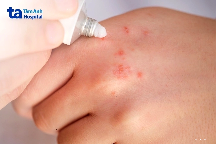 Chỉ cần dùng một lớp mỏng corticoid để điều trị da trẻ em