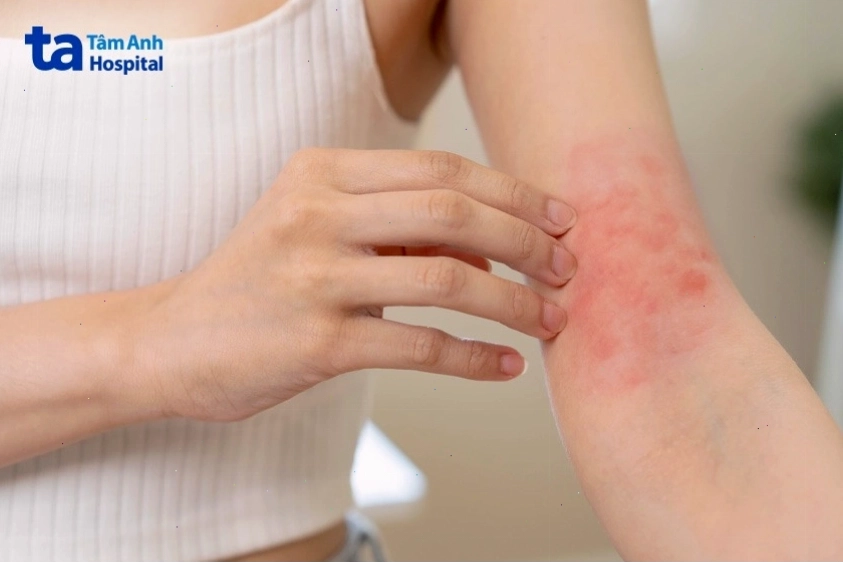Da bị đỏ và kích ứng sau khi triệt lông