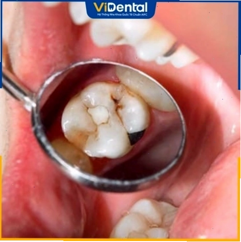 Đau nhức kéo dài sau khi trám răng ảnh hưởng đến tâm sinh lý