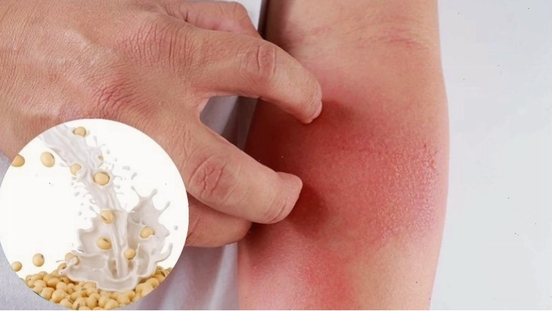 Dị ứng sữa đậu nành có thể dẫn đến phát ban và nổi mề đay
