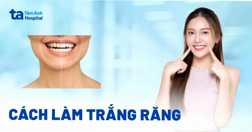 Kết quả tẩy trắng răng không đồng đều, chỗ trắng chỗ vàng
