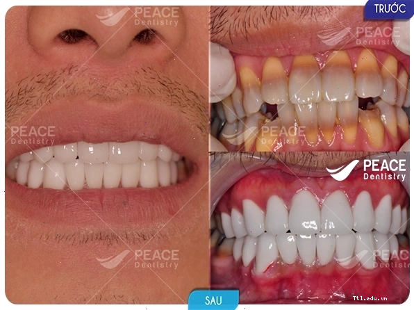 Khách hàng hài lòng sau khi bọc răng sứ