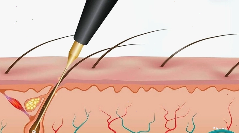 Kỹ thuật triệt lông đốt điện có thể gây bỏng rát