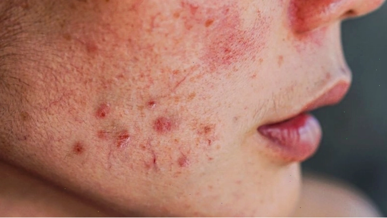 Lạm dụng corticoid làm bùng phát mụn trứng cá khó kiểm soát