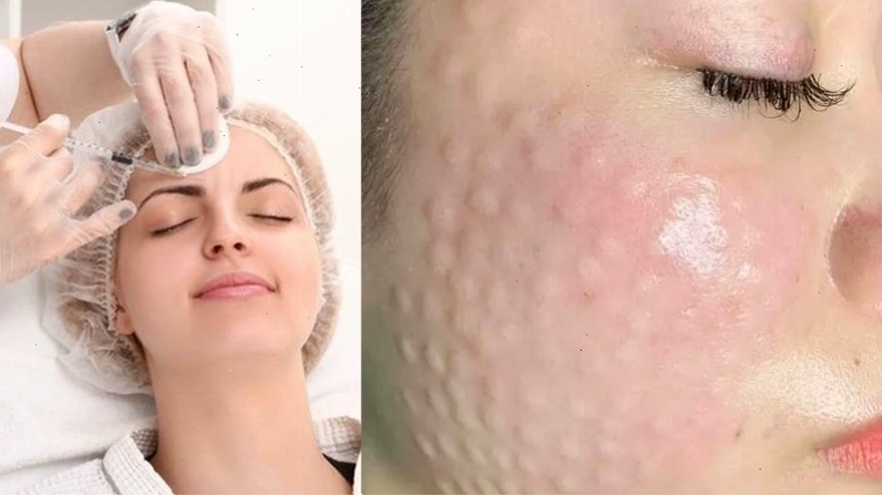 Làn da căng bóng mịn màng sau khi tiêm meso