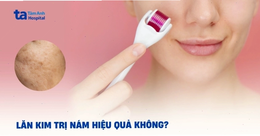 Liệu trình lăn kim hỗ trợ cải thiện làn da