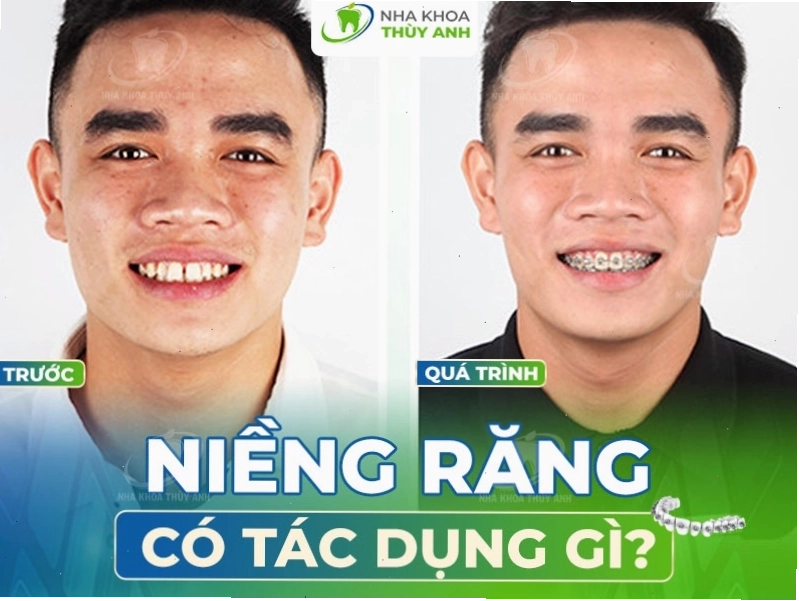 Lợi ích của niềng răng đối với thẩm mỹ nụ cười