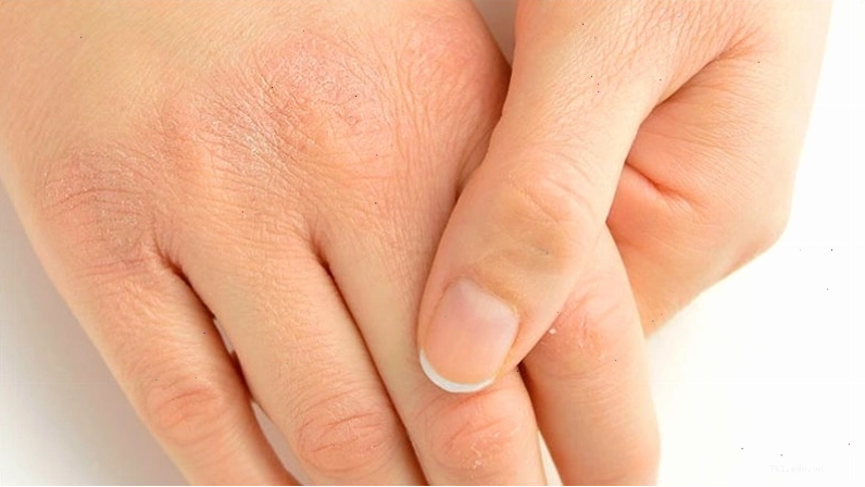 Mức độ teo da phụ thuộc vào độ mạnh của corticoid trên da mặt