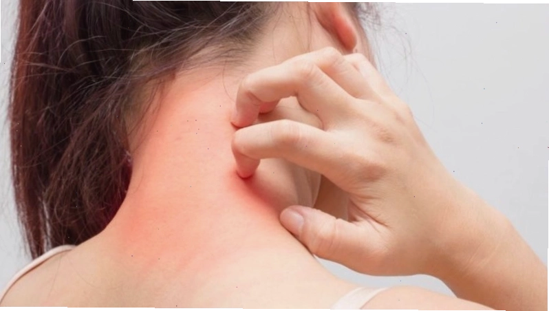 Người có cơ địa nhạy cảm có thể bị dị ứng với cây bồ công anh