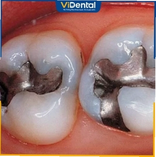 Nguy cơ ngộ độc chất trám Amalgam