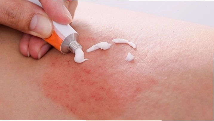 Nhiều nang lông bị viêm gây khó chịu