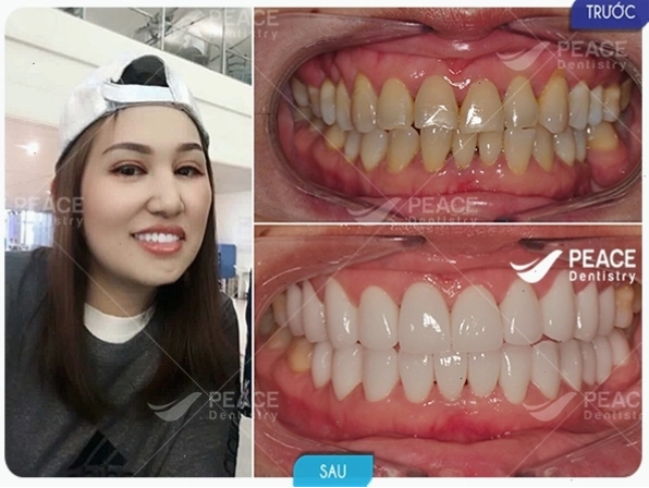 Nụ cười rạng rỡ sau khi bọc răng sứ