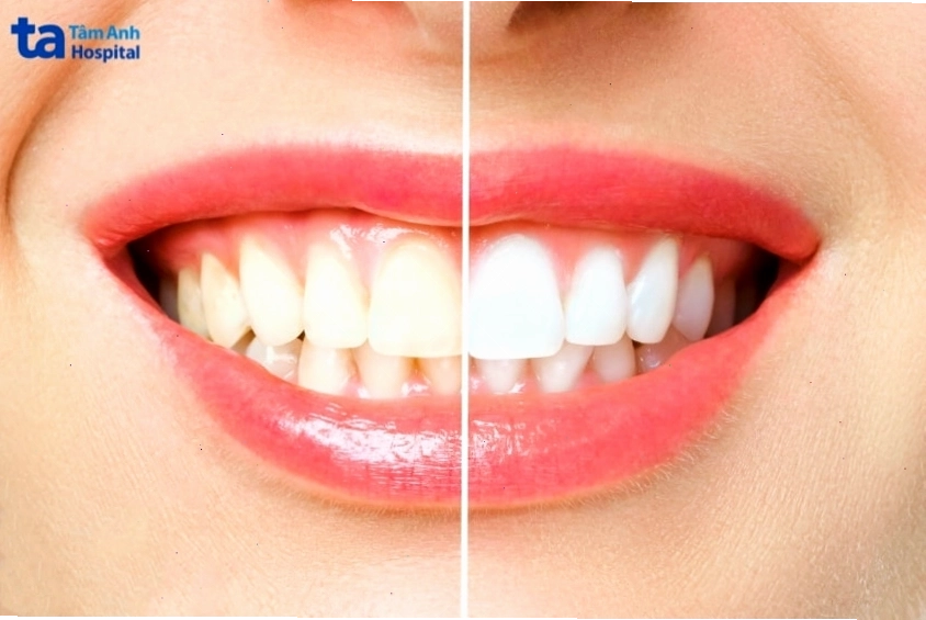 Nướu bị kích ứng và sưng đỏ do tiếp xúc với thuốc tẩy trắng