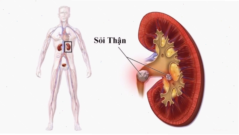 Oxalate có thể kết hợp với canxi trong nước tiểu và tích tụ thành sỏi thận