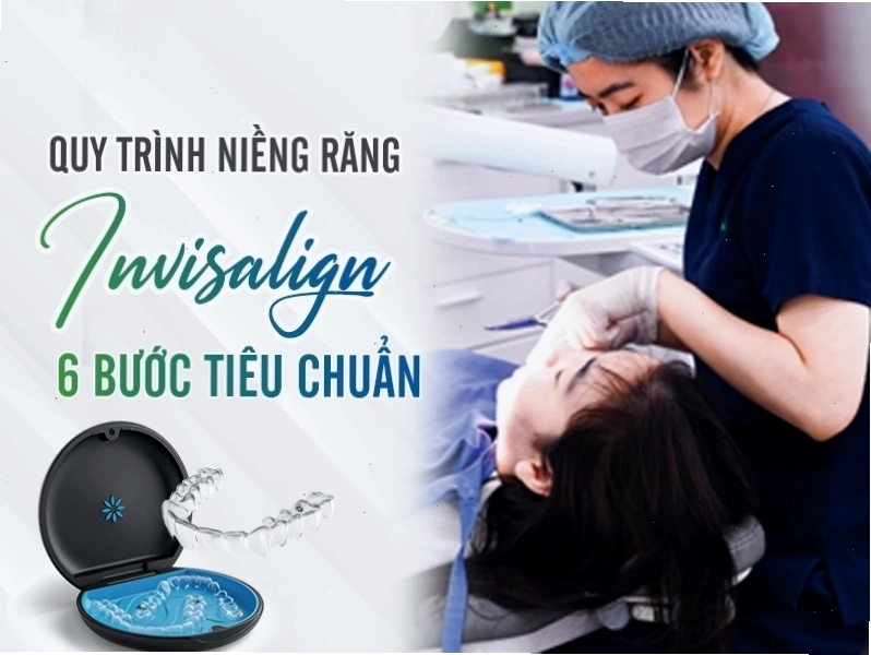 Quy trình niềng răng Invisalign 6 bước tiêu chuẩn