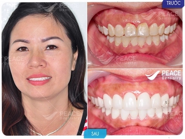 Răng sứ có màu sắc trắng tự nhiên hài hòa với da