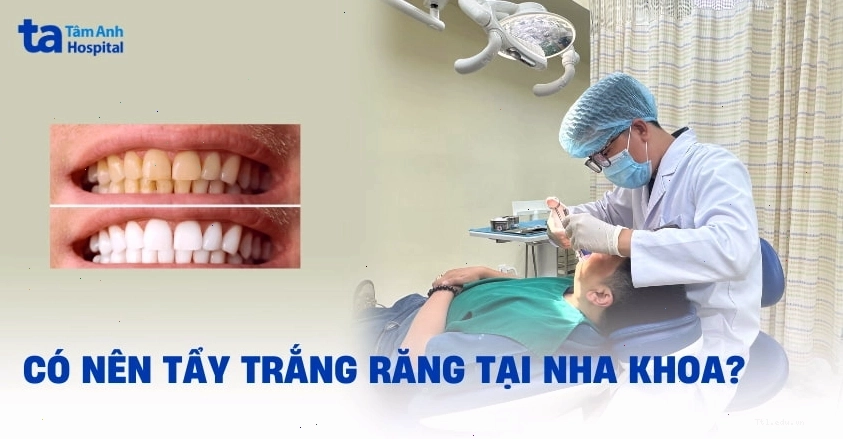 So sánh tẩy trắng răng tại nhà và tại nha khoa