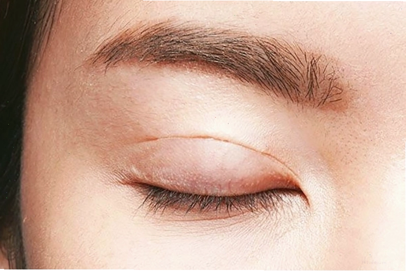 Tác hại của cắt mí mắt và những điều cần biết trước khi làm đẹp