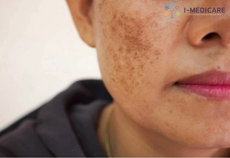 Tác hại của việc trị nám bằng laser khi thực hiện sai cách - Ảnh minh họa