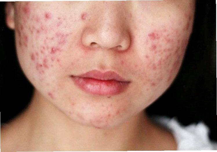 Thức khuya gây nổi mụn trứng cá