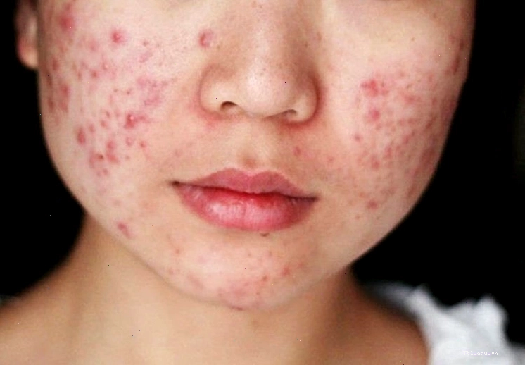 Thức khuya gây nổi mụn trứng cá và các vấn đề về da ở phụ nữ