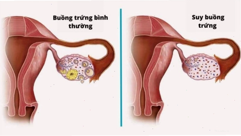 Tiêu thụ đậu nành ở mức quá cao có thể làm suy giảm chức năng buồng trứng