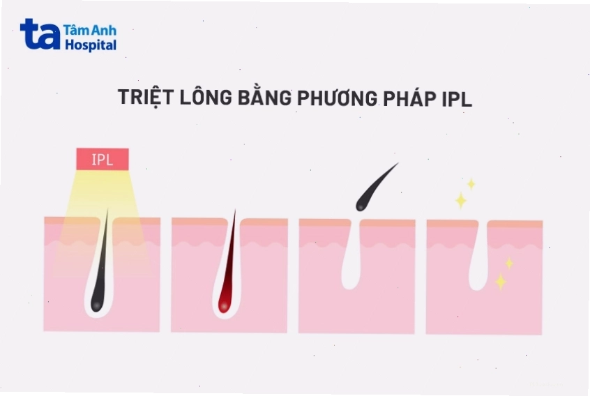 Triệt lông bằng công nghệ IPL