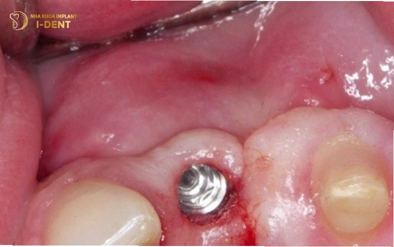 Vùng cấy implant bị nhiễm trùng gây sưng đỏ và đau nhức