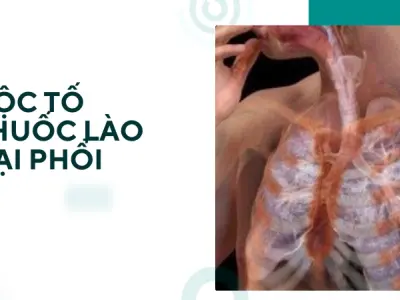 Thuốc lào và những trải nghiệm thực tế về cái bẫy sức khỏe đó