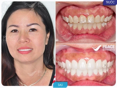 Bí quyết sở hữu nụ cười răng đẹp mê hoặc