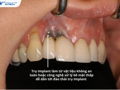 Rủi ro khi trồng răng implant: Cảnh báo và lưu ý bạn cần biết