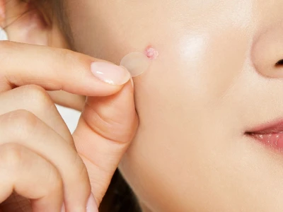Tác hại của miếng dán mụn: Nguy cơ tiềm ẩn và cách sử dụng hiệu quả