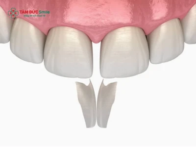 Tác hại của việc trám răng và cách phòng tránh hiệu quả