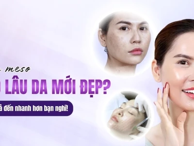 Tiêm Meso Bao Lâu Thì Đẹp? Yếu Tố Ảnh Hưởng & Lưu Ý